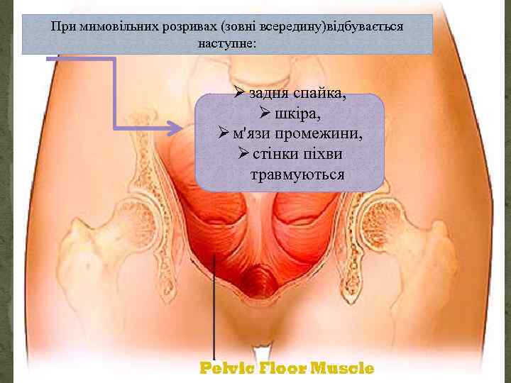 При мимовільних розривах (зовні всередину)відбувається наступне: Ø задня спайка, Ø шкіра, Ø м'язи промежини,