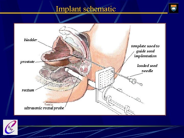 Implant schematic 