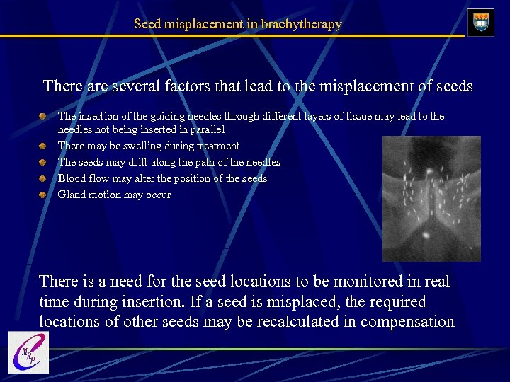 Seed misplacement in brachytherapy There are several factors that lead to the misplacement of