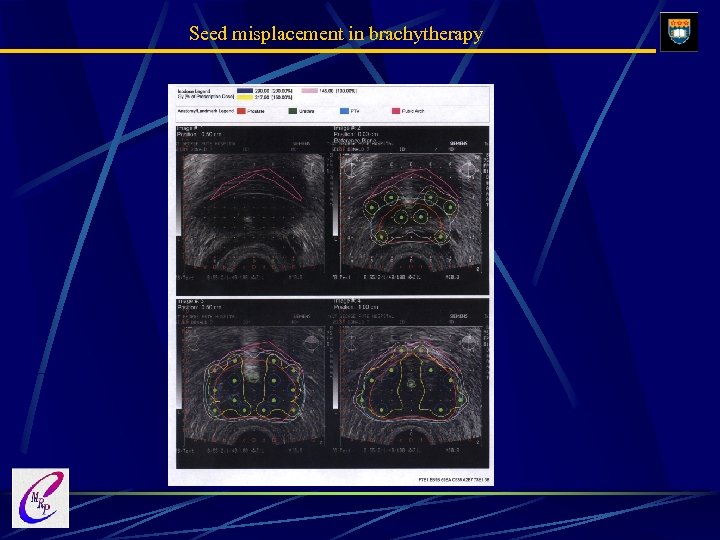 Seed misplacement in brachytherapy 