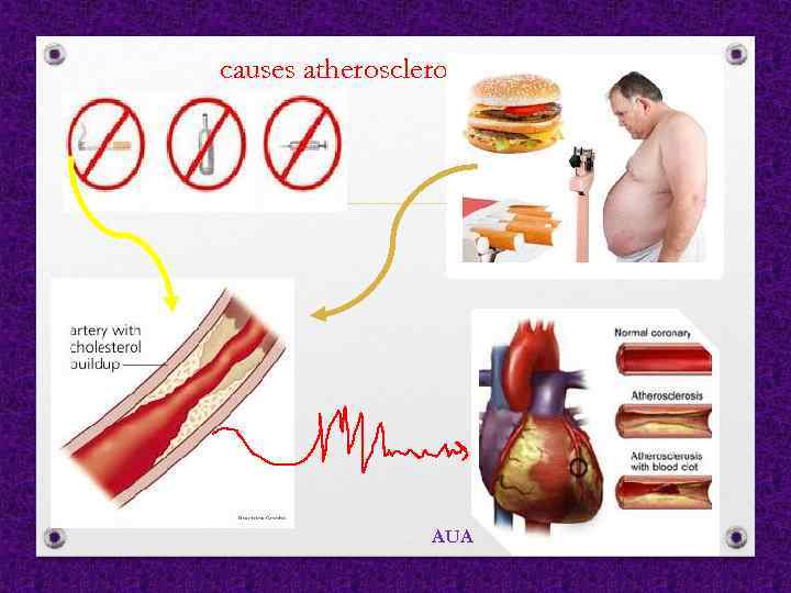 causes atherosclerosis AUA 