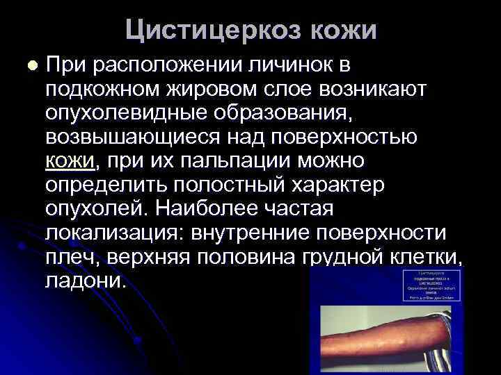 Цистицеркоз кожи l При расположении личинок в подкожном жировом слое возникают опухолевидные образования, возвышающиеся
