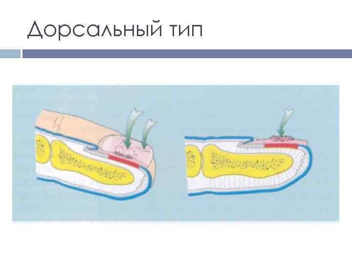 Дорсальный тип 