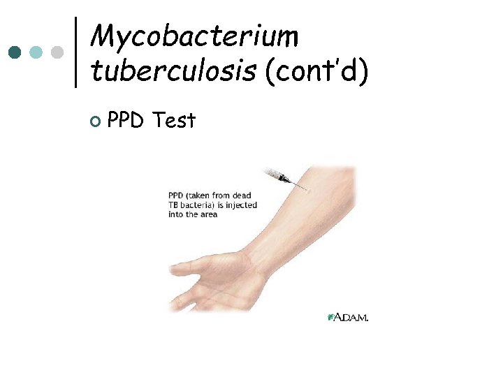 Mycobacterium tuberculosis (cont’d) ¢ PPD Test 