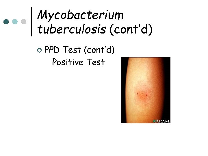 Mycobacterium tuberculosis (cont’d) ¢ PPD Test (cont’d) Positive Test 