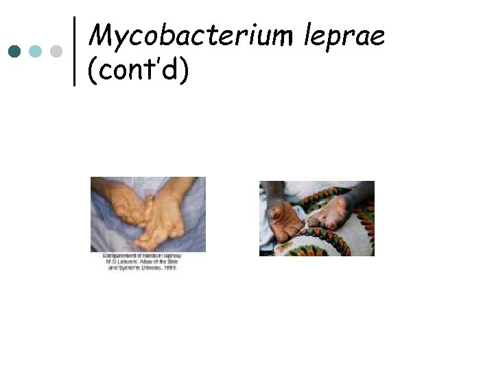 Mycobacterium leprae (cont’d) 