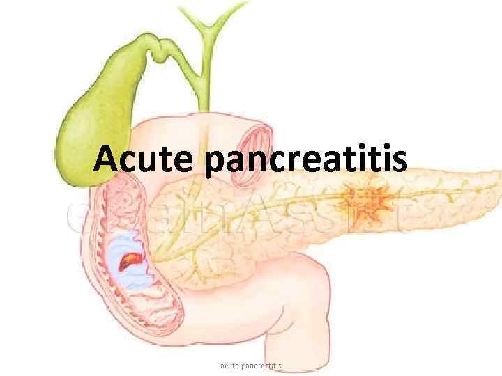 Acute pancreatitis acute pancreatitis 