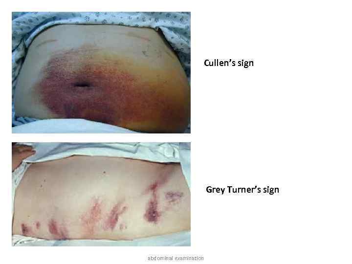 Cullen’s sign Grey Turner’s sign abdominal examination 