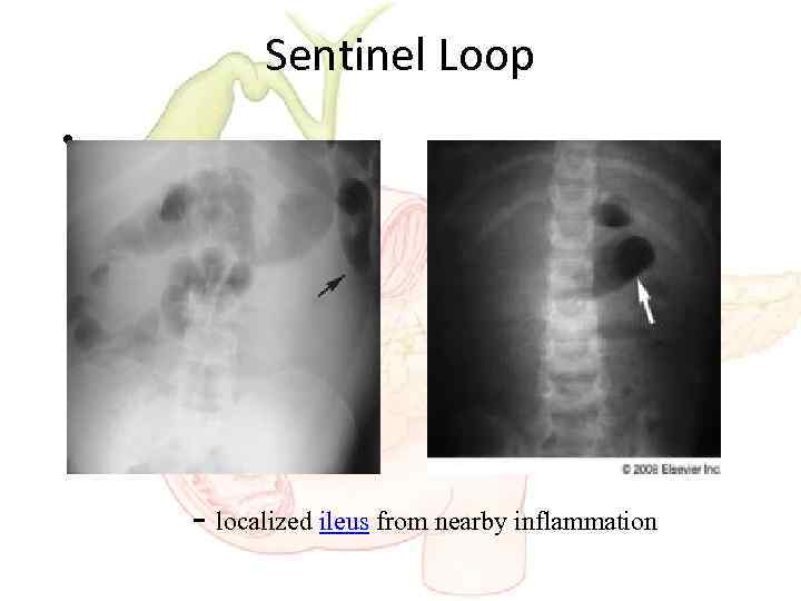 Sentinel Loop • - localized ileus from nearby inflammation 
