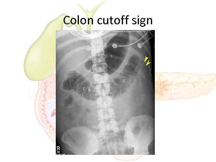 Colon cutoff sign 