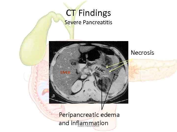 CT Findings Severe Pancreatitis Necrosis GB LIVER PAN C Peripancreatic edema and inflammation Acute