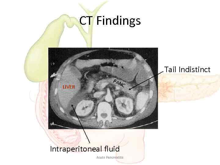 CT Findings Tail Indistinct LIVER PAN C Intraperitoneal fluid Acute Pancreatitis 