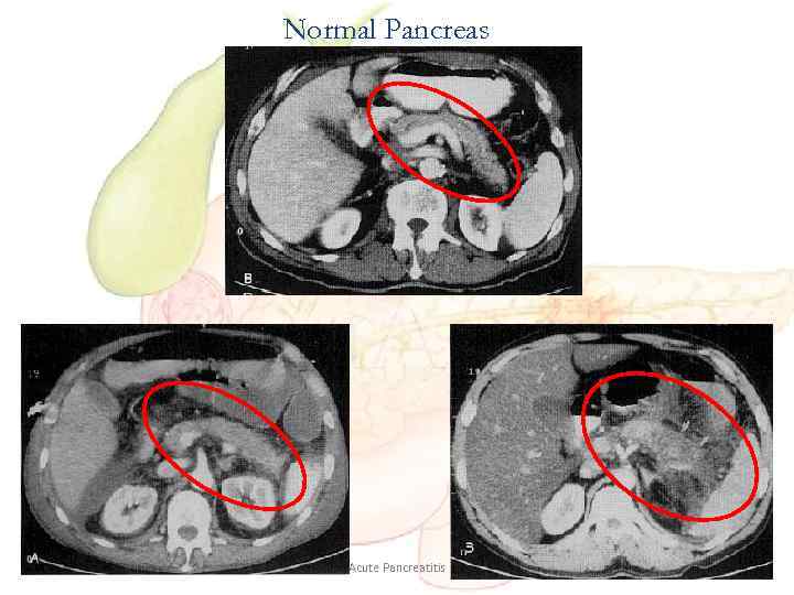 Normal Pancreas Acute Pancreatitis 