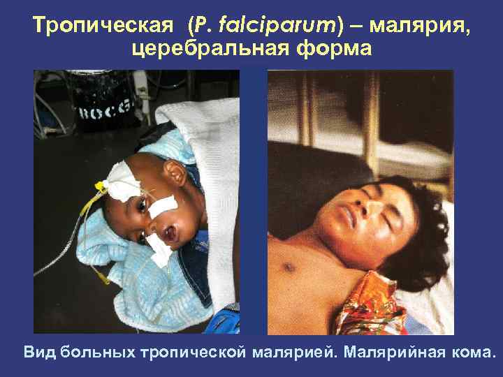 Тропическая (P. falciparum) – малярия, церебральная форма Вид больных тропической малярией. Малярийная кома. 