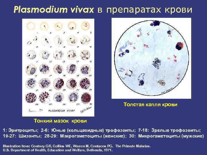 Кровь на малярию. Плазмодии малярии в толстой капле крови. Плазмодиум Вивакс мазок крови. Малярийный плазмодий в тонком мазке крови. Plasmodium Vivax препарат.
