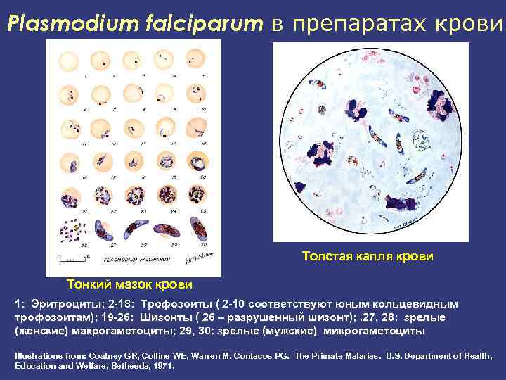 Plasmodium falciparum в препаратах крови Толстая капля крови Тонкий мазок крови 1: Эритроциты; 2