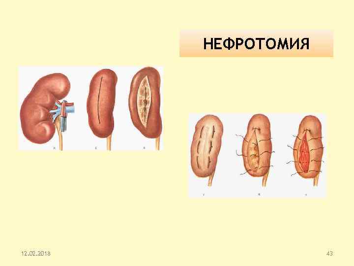 Нефропексия это