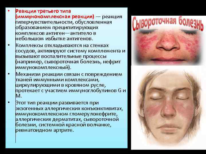  • Реакция третьего типа (иммунокомплексная реакция) — реакция гиперчувствительности, обусловленная образованием преципитирующих комплексов