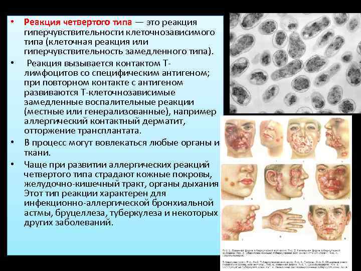  • Реакция четвертого типа — это реакция гиперчувствительности клеточнозависимого типа (клеточная реакция или