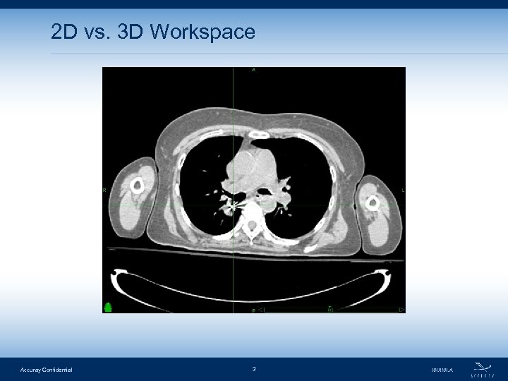 2 D vs. 3 D Workspace Accuray Confidential 3 XXXXX. A 
