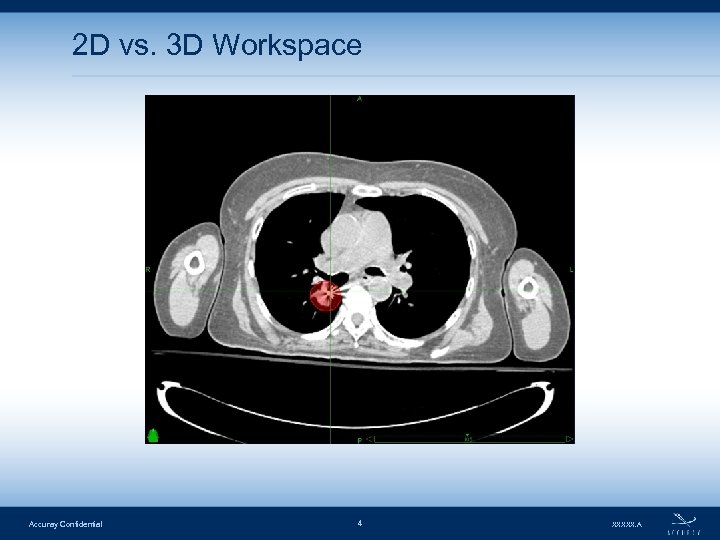 2 D vs. 3 D Workspace Accuray Confidential 4 XXXXX. A 
