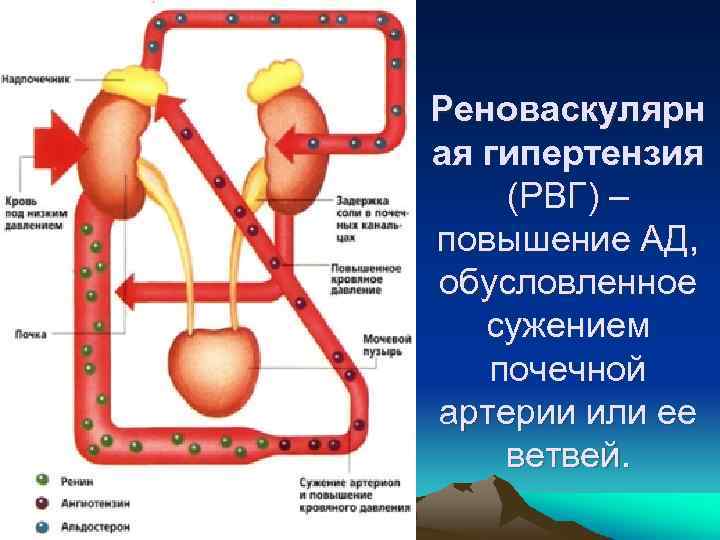 Реноваскулярн ая гипертензия (РВГ) – повышение АД, обусловленное сужением почечной артерии или ее ветвей.