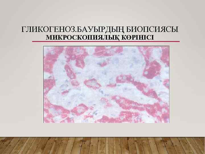 ГЛИКОГЕНОЗ. БАУЫРДЫҢ БИОПСИЯСЫ МИКРОСКОПИЯЛЫҚ КӨРІНІСІ 