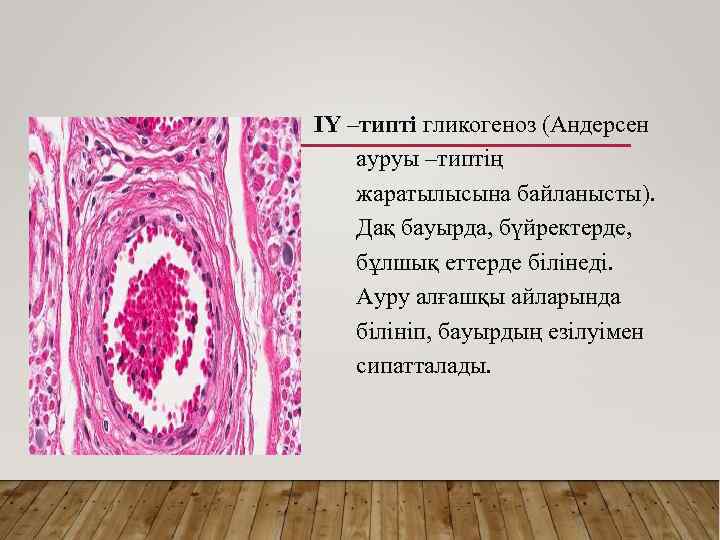 IY –типті гликогеноз (Андерсен ауруы –типтің жаратылысына байланысты). Дақ бауырда, бүйректерде, бұлшық еттерде білінеді.