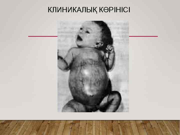 КЛИНИКАЛЫҚ КӨРІНІСІ 