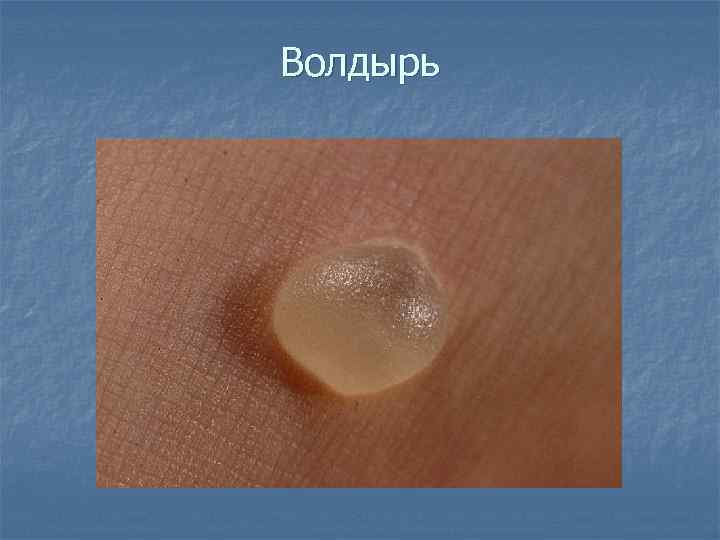 Волдырь 