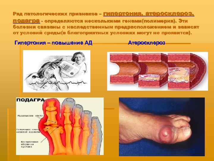 Ряд патологических признаков – гипертония, атеросклероз, подагра - определяются несколькими генами(полимерия). Эти болезни связаны