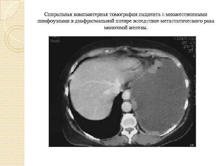 Спиральная компьютерная томография пациента с множественными лимфоузлами в диафрагмальной плевре вследствие метастатического рака молочной