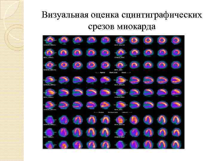 Визуальная оценка сцинтиграфических срезов миокарда 