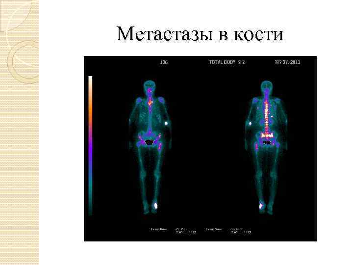 Метастазы в кости 