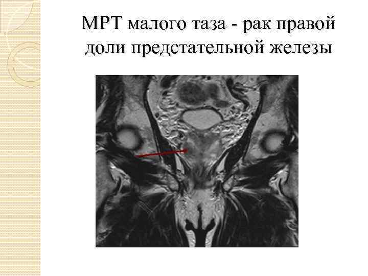 МРТ малого таза - рак правой доли предстательной железы 