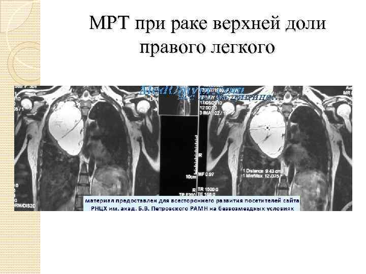 МРТ при раке верхней доли правого легкого 