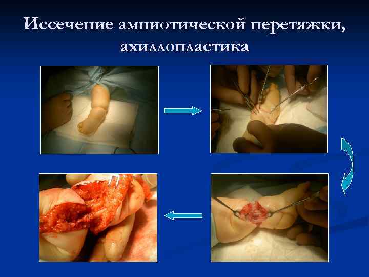Иссечение амниотической перетяжки, ахиллопластика 