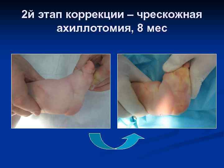 2 й этап коррекции – чрескожная ахиллотомия, 8 мес 