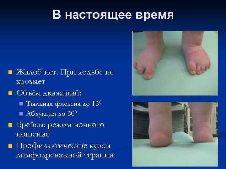 В настоящее время n n Жалоб нет. При ходьбе не хромает Объём движений: n