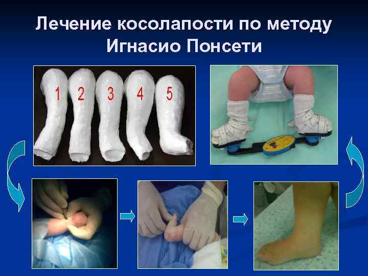Лечение косолапости по методу Игнасио Понсети 