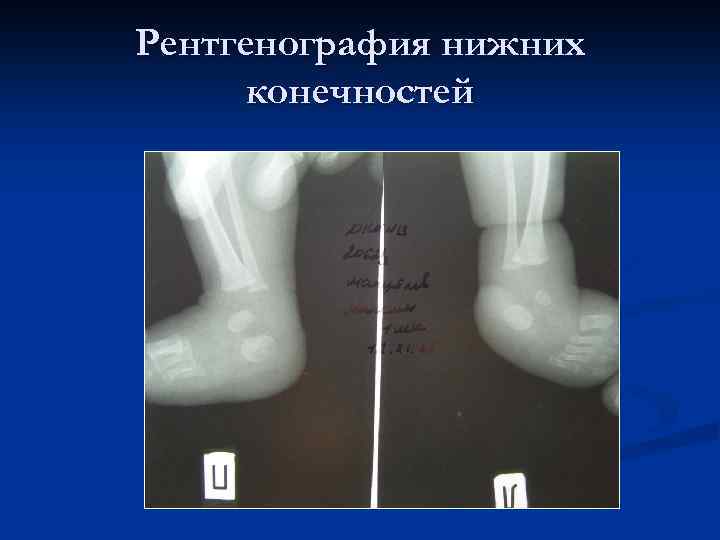 Рентгенография нижних конечностей 