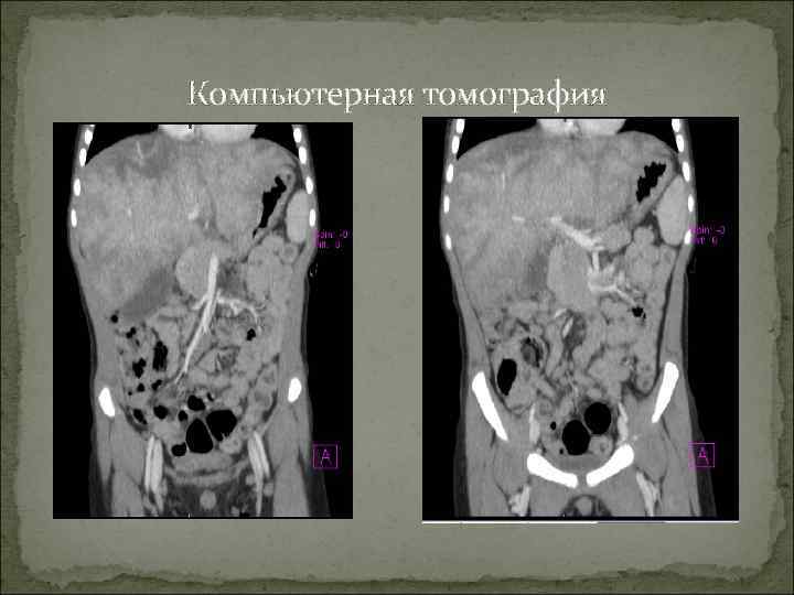 Компьютерная томография 