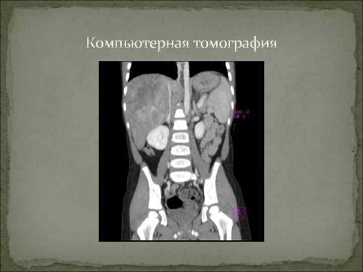 Компьютерная томография 