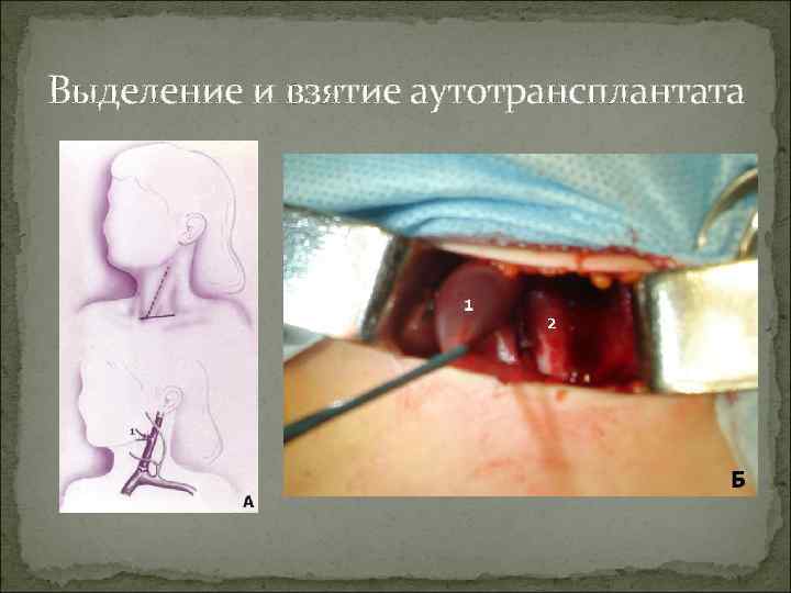 Выделение и взятие аутотрансплантата 