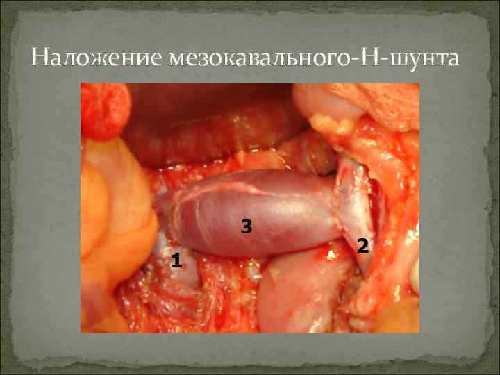 Наложение мезокавального-H-шунта 