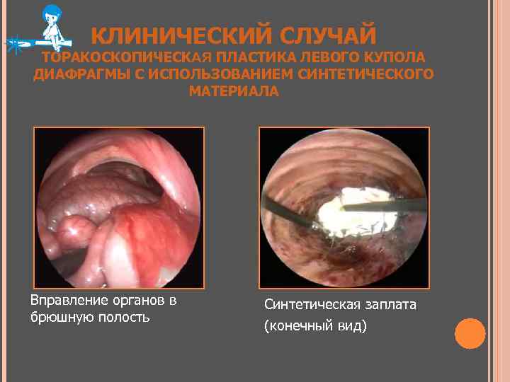КЛИНИЧЕСКИЙ СЛУЧАЙ ТОРАКОСКОПИЧЕСКАЯ ПЛАСТИКА ЛЕВОГО КУПОЛА ДИАФРАГМЫ С ИСПОЛЬЗОВАНИЕМ СИНТЕТИЧЕСКОГО МАТЕРИАЛА Вправление органов в