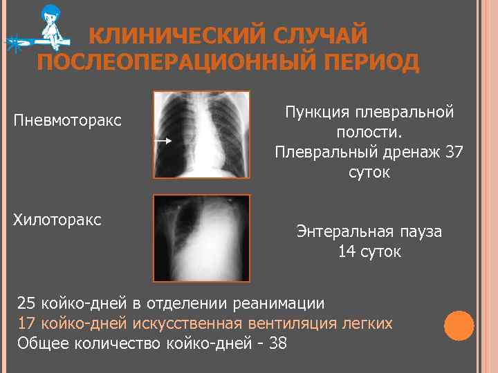 КЛИНИЧЕСКИЙ СЛУЧАЙ ПОСЛЕОПЕРАЦИОННЫЙ ПЕРИОД Пневмоторакс Хилоторакс Пункция плевральной полости. Плевральный дренаж 37 суток Энтеральная