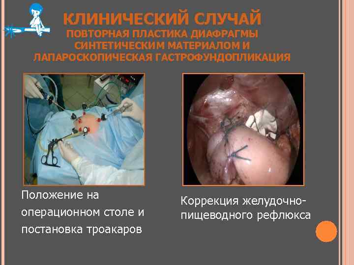 КЛИНИЧЕСКИЙ СЛУЧАЙ ПОВТОРНАЯ ПЛАСТИКА ДИАФРАГМЫ СИНТЕТИЧЕСКИМ МАТЕРИАЛОМ И ЛАПАРОСКОПИЧЕСКАЯ ГАСТРОФУНДОПЛИКАЦИЯ Положение на операционном столе
