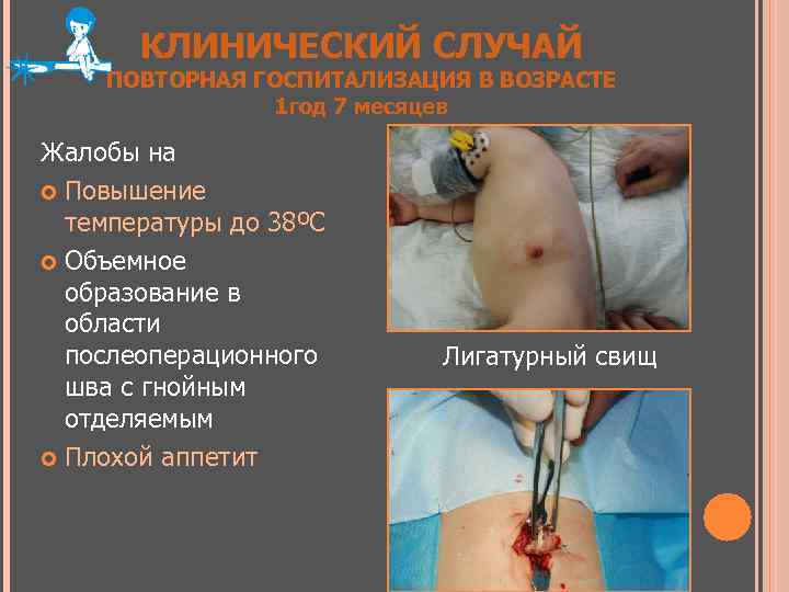 КЛИНИЧЕСКИЙ СЛУЧАЙ ПОВТОРНАЯ ГОСПИТАЛИЗАЦИЯ В ВОЗРАСТЕ 1 год 7 месяцев Жалобы на Повышение температуры