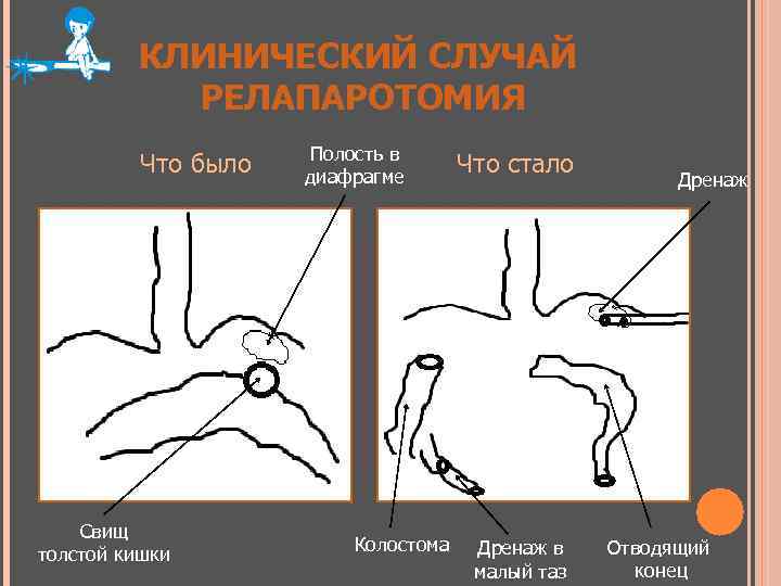 КЛИНИЧЕСКИЙ СЛУЧАЙ РЕЛАПАРОТОМИЯ Что было Свищ толстой кишки Полость в диафрагме Колостома Что стало